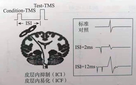 科普丨前途無量的TMS新模式——單拍成對脈沖刺激（pTMS）